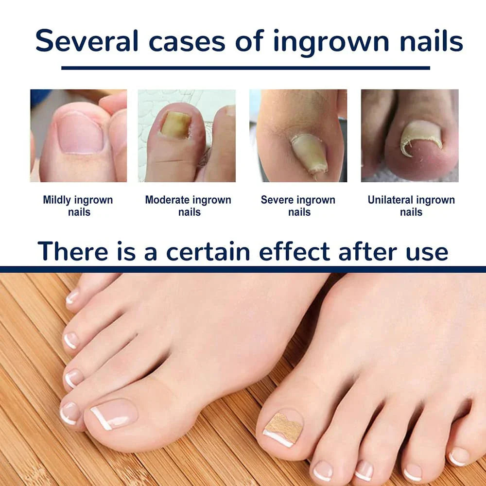 Ingrown Toenail Corrector Patches Nail Correction Care