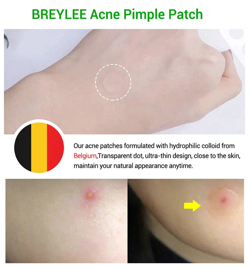 Mm Acne Pimple Patch Stickers Waterproof Acne Treatment