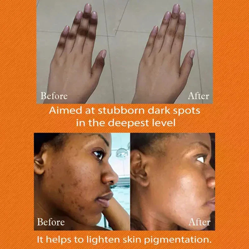 Anti Acanthosis Nigricans Whitening Cream Remove Melanin Armpit