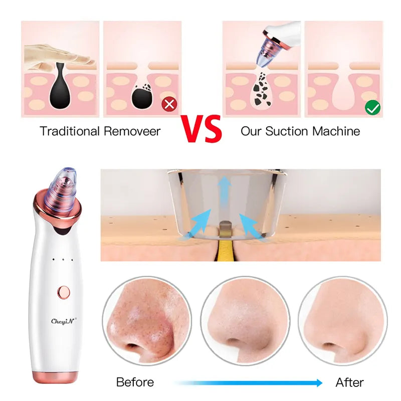 Ckeyin Electric Blackhead Remover Vacuum Facial Acne Cleaner