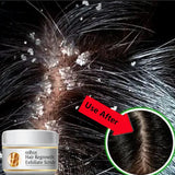 Fast Anti Dandruff Hair Treatment Scrub Itching Repair