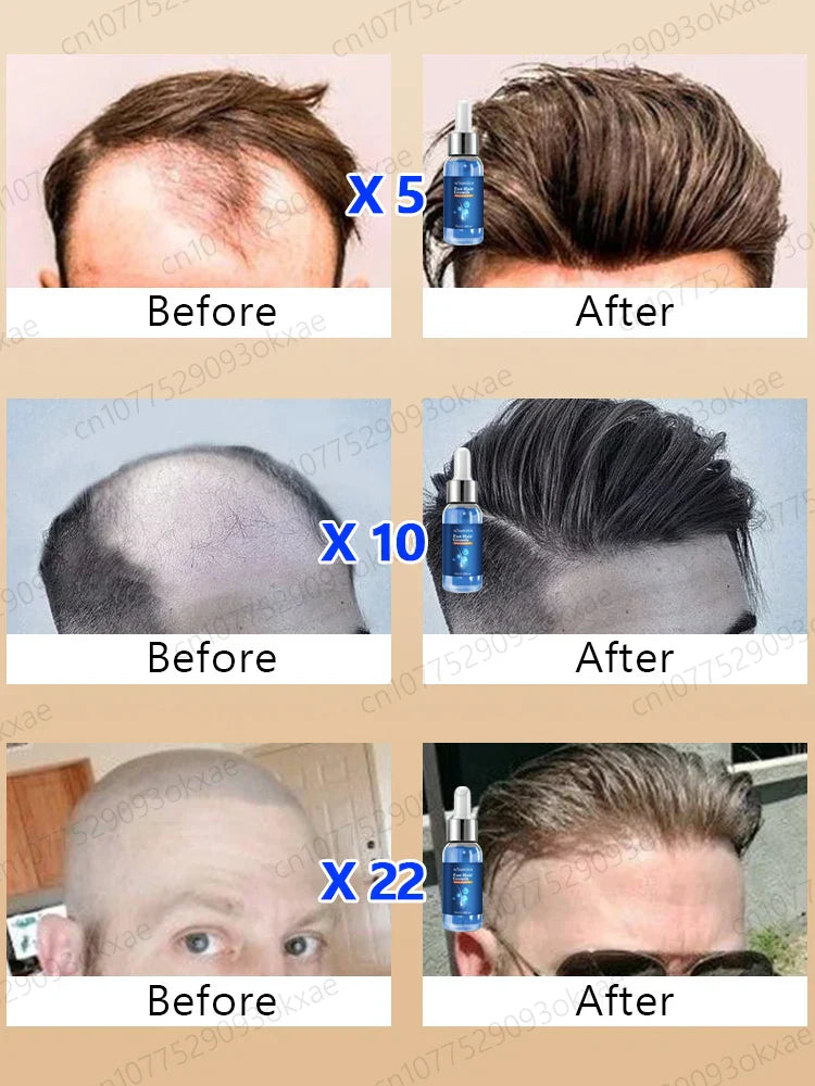 Fast Hair Growth Essence Oil Products Effective Baldness