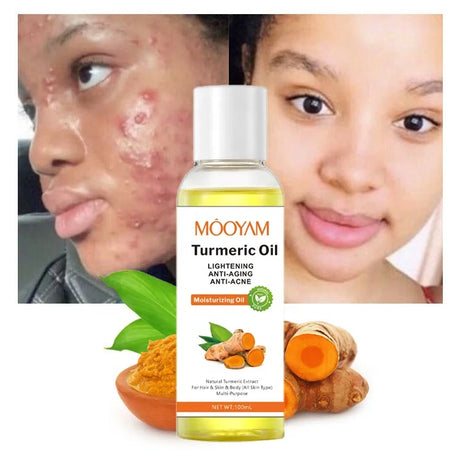 Turmeric Oil Face Whitening Lightening Acne Dark Patches