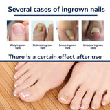 Ingrown Toenail Corrector Patches Nail Correction Care