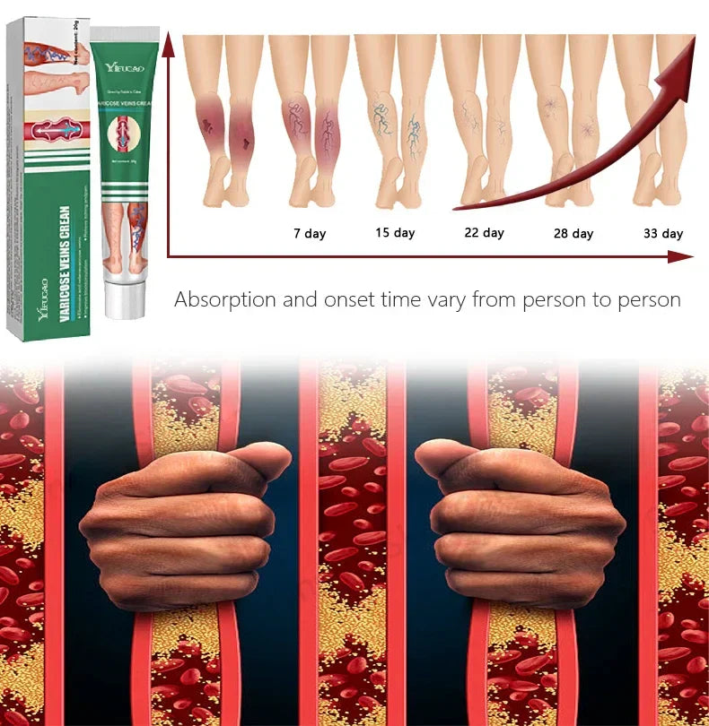 Varicose Vein Treatments Cream Effective Relieve Legs Dilated
