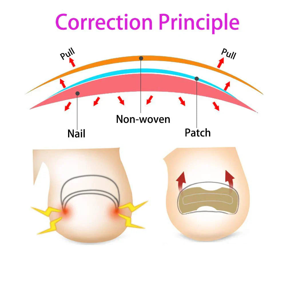 Ingrown Toenail Corrector Patches Nail Correction Care