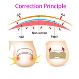 Ingrown Toenail Corrector Patches Nail Correction Care