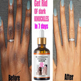 Get Rid Of Dark Knuckles In Days