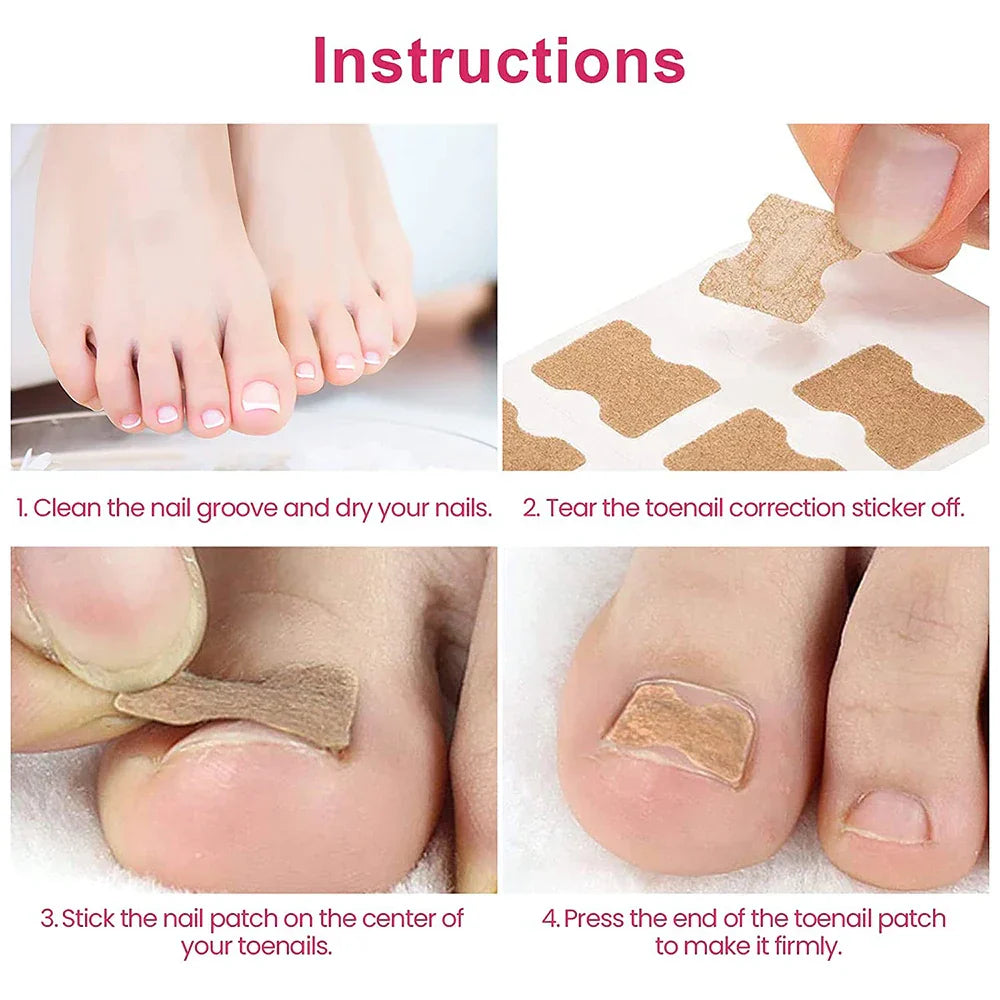 Ingrown Toenail Corrector Patches Nail Correction Care