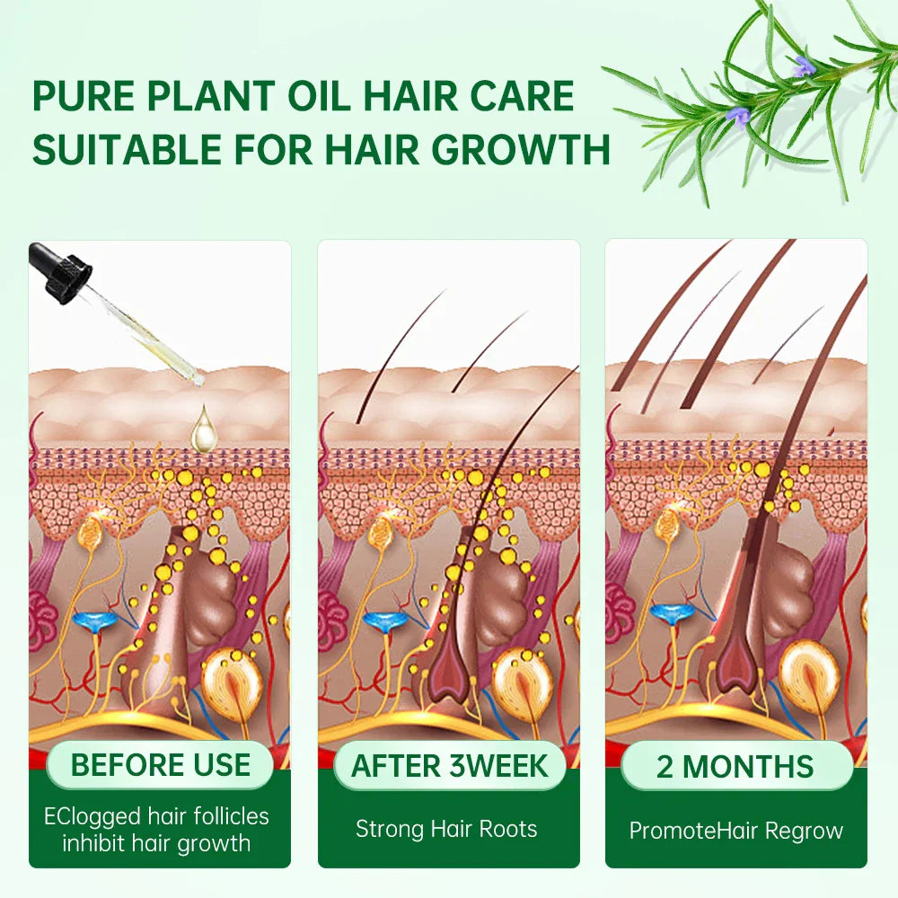 Purc Rosemary Oil Hair Growth For Men Women