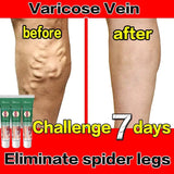 Varicose Vein Treatments Cream Effective Relieve Legs Dilated